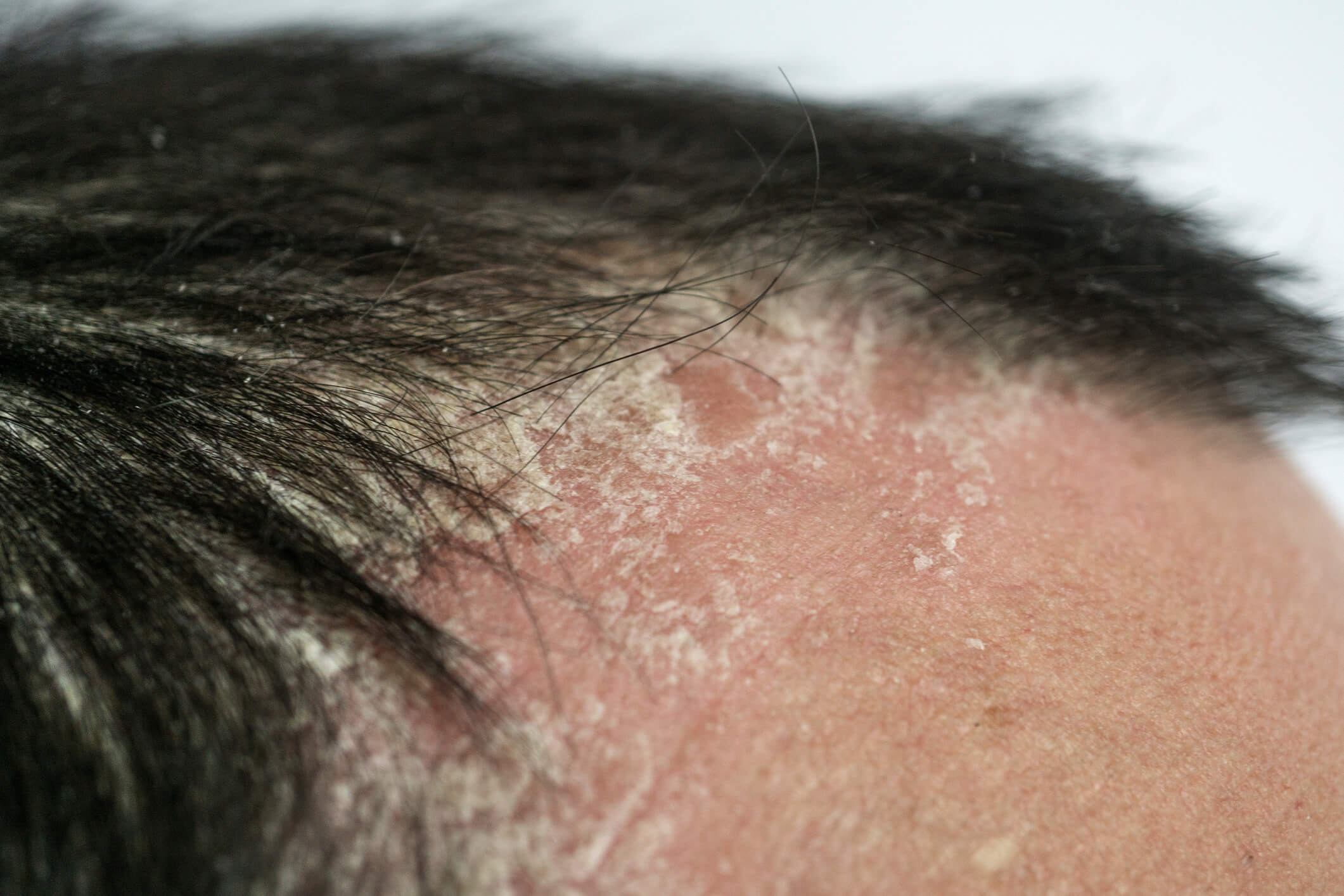 5 doenças do couro cabeludo que você precisa ficar de olho