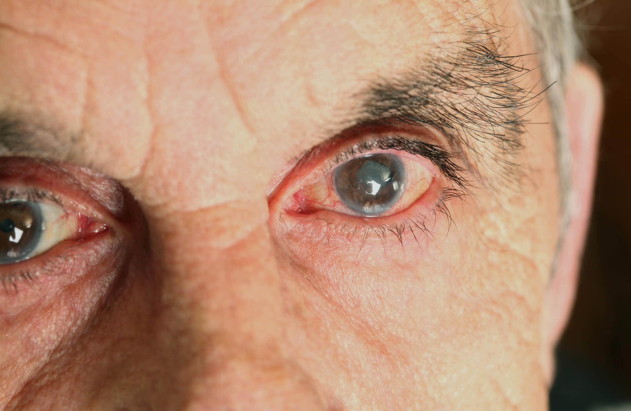 Olhos amarelados: 10 principais causas, sintomas e o que fazer